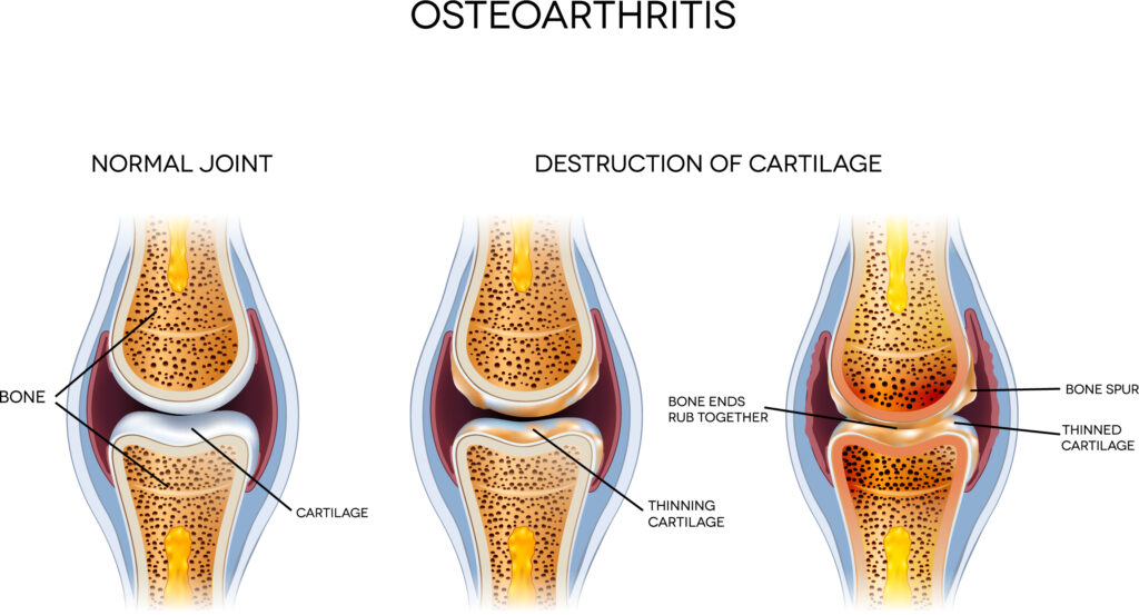 A picture of osteoarthritis vs a normal joint.