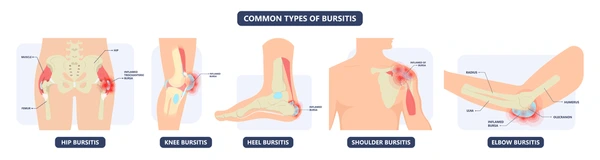 A picture of the common areas of bursitis.