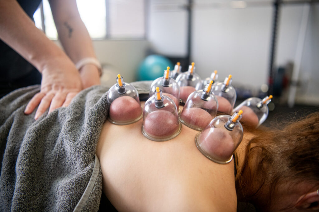 An image of cupping therapy