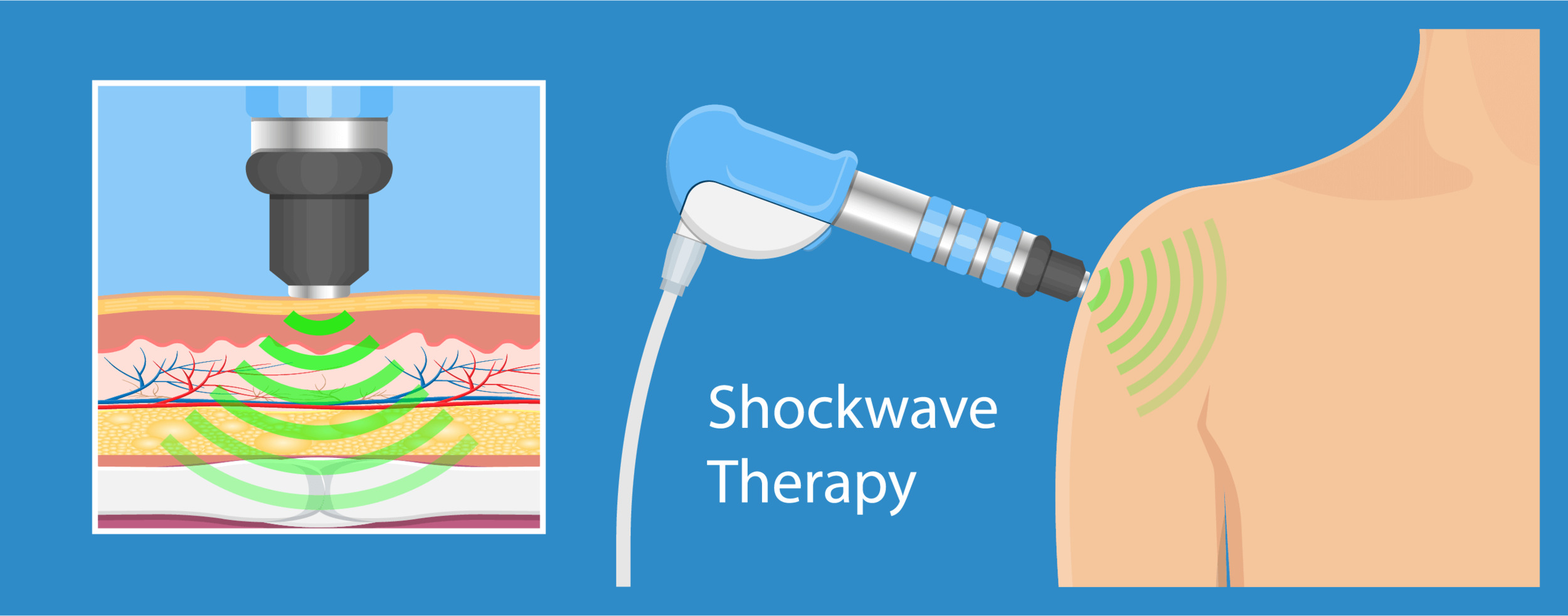 SHOCKWAVE THE PAIN AWAY